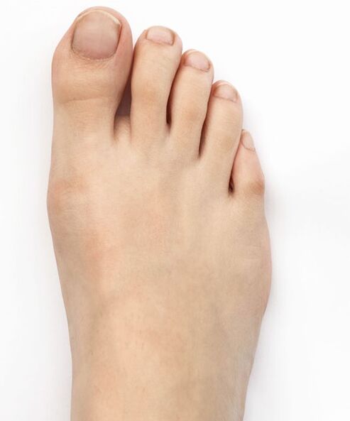 Curei o valgo do polgar co spray Hondro Sol Valgus