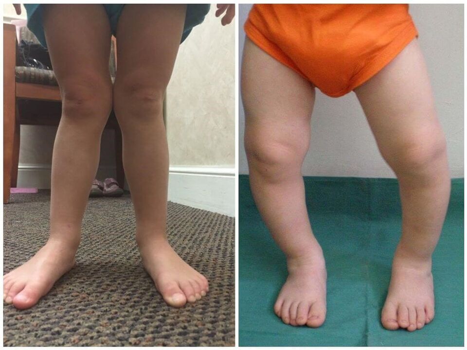 A deformación do valgus nos nenos causas
