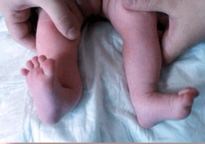 A deformación do valgus nos síntomas dos nenos