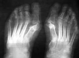 Indicacións para as operacións baixo o valgus do pé