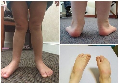 Deformación de valgus nos nenos