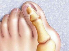 Hallux Valgus Deformidade