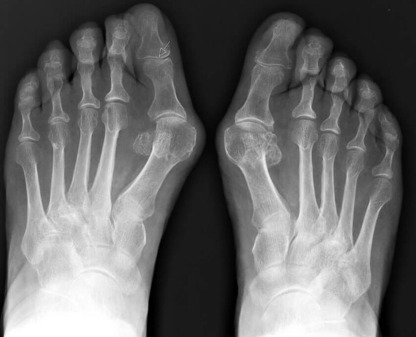 Radiografía de hallux valgus