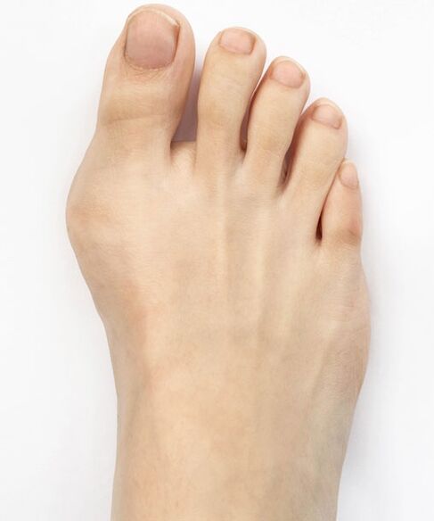 hallux valgus antes de usar Hondro Sol Valgus spray